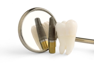 implanty - klinika dentystyczna Froe